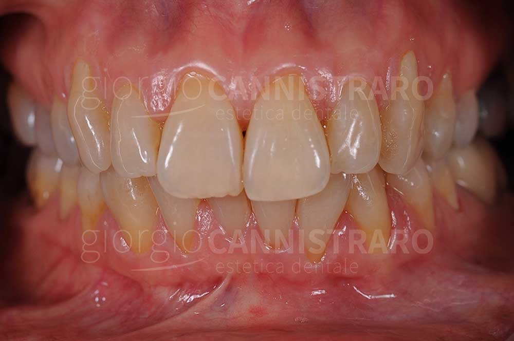 sbiancamento dentale