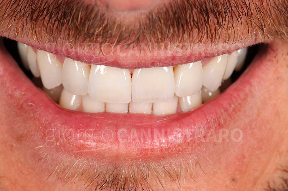 faccette dentali
