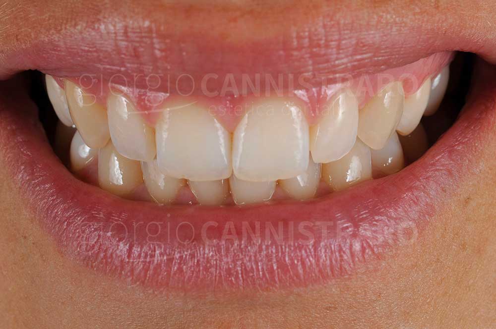 faccette dentali