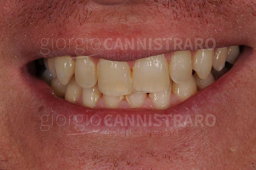 sbiancamento dentale