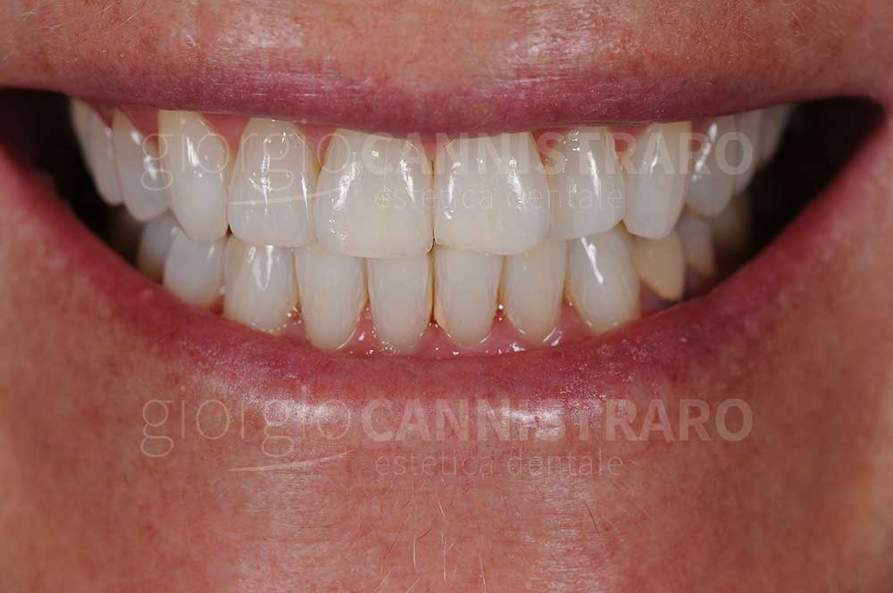 sbiancamento dentale