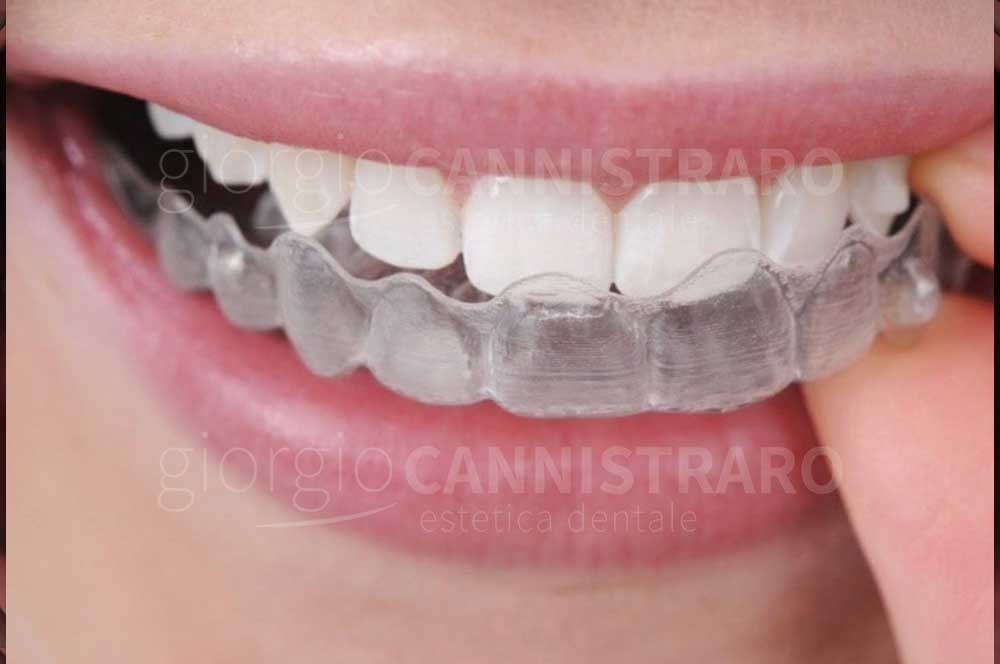 ortodonzia invisibile