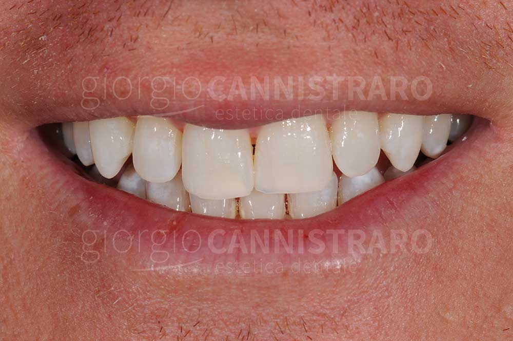 sbiancamento dentale