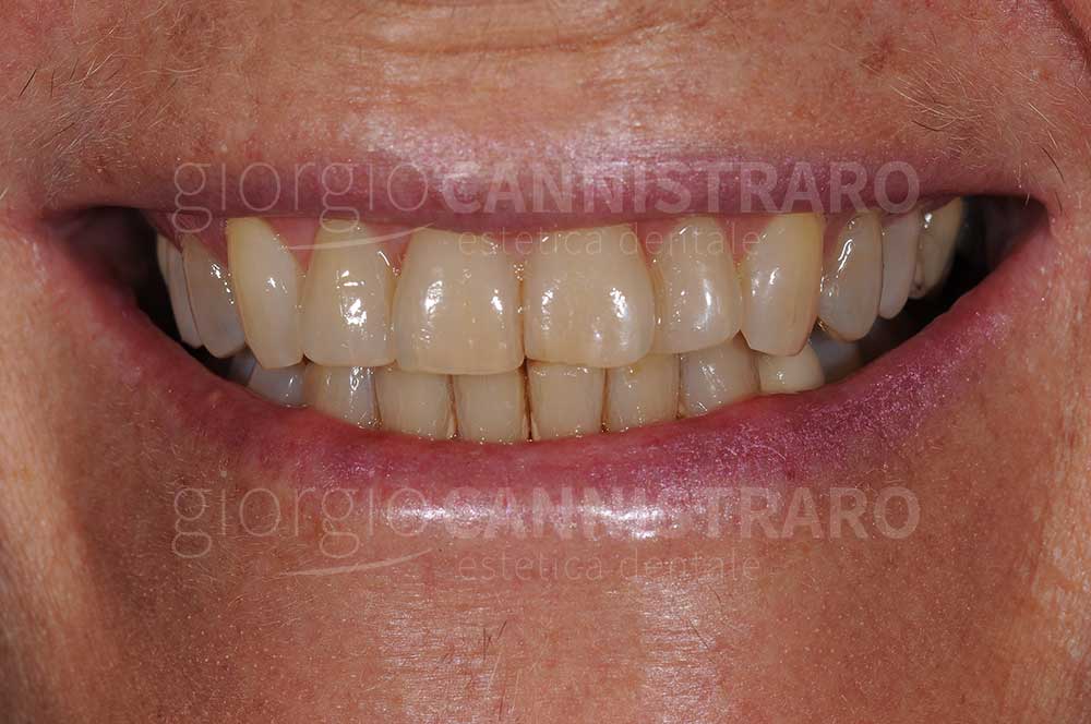 sbiancamento dentale